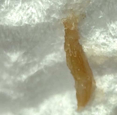 Sebum Plug / Keratin Plug (Not actually a bug)