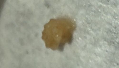 Tonsil Stone (Calcified debris)