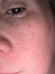 Demodex Mite (often referred to as face mites or eyelash mites)