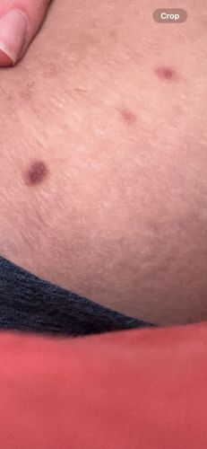 There is no insect visible in the image. The image shows what appears to be human skin with several reddish-purplish spots. These spots resemble bites or skin lesions and are not identifiable as an insect.