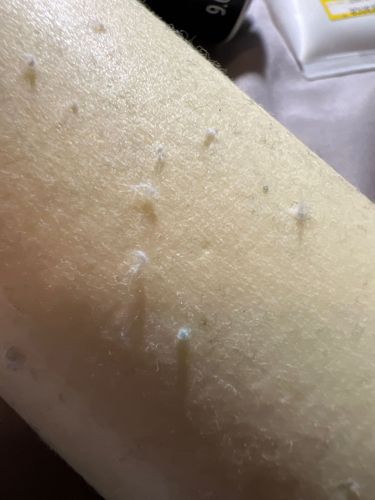 No insect or bug identifiable