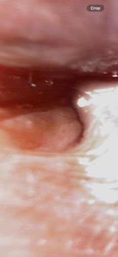 Tonsil Stone (Not an insect)