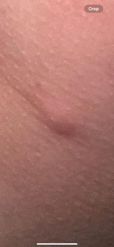 Unknown (Skin reaction)