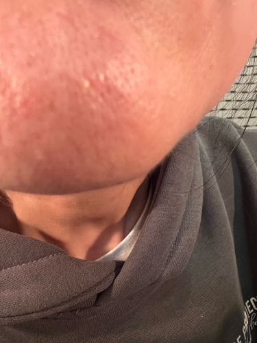 Acne Pimple (not an insect)