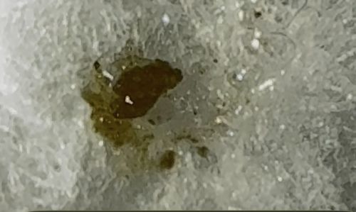 Pubic Louse (Crab Louse)