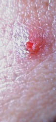 Chigger (Red Bug or Harvest Mite Larva)