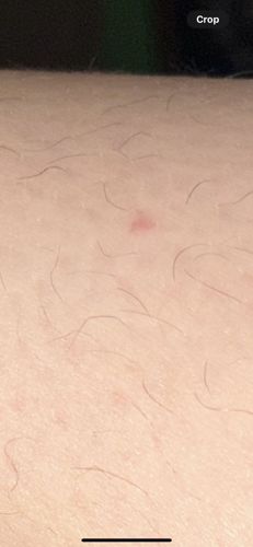 There is no identifiable bug or insect in the image. The image shows human skin with hair follicles and a small red mark, possibly an irritation, a small bite mark, or a minor skin lesion. Without a visible insect, identification is not possible.