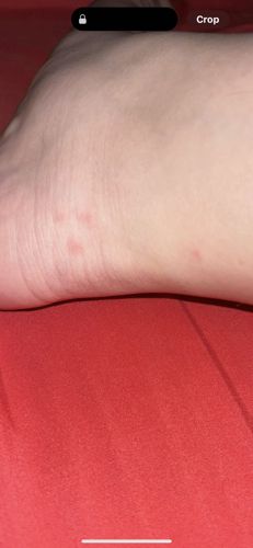 Sand Flea / Chigoe Flea