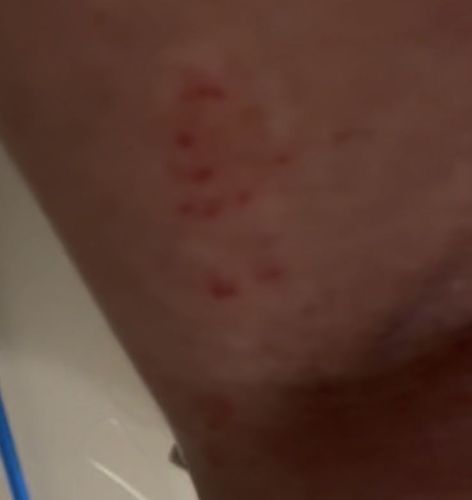 Bed bug