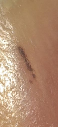 Not an insect (likely dirt, debris, or a skin marking)