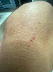 Bed Bug (suspected bite marks shown; specimen not visible)