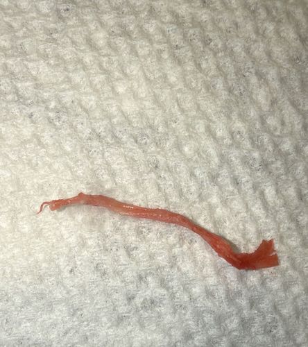 Pinworm (Potential)