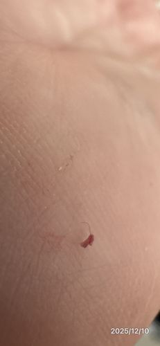 Ingrown Hair