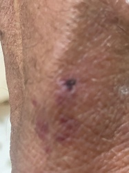 Black-legged tick (Deer tick)