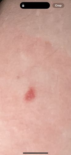 N/A - The image displays a red mark or rash on skin, not an insect.