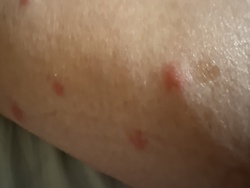 Bed Bug