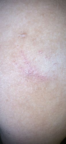 Human Itch Mite (Scabies)