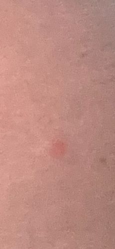 Chigger (Larval Mite)