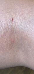 Hard Tick