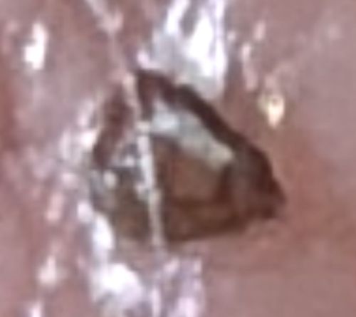 Pubic Louse (Crab Louse)