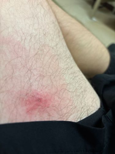 No insect identified