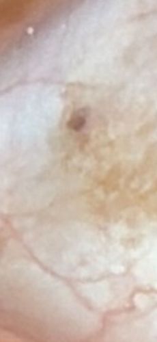 Pubic louse (Crab louse)