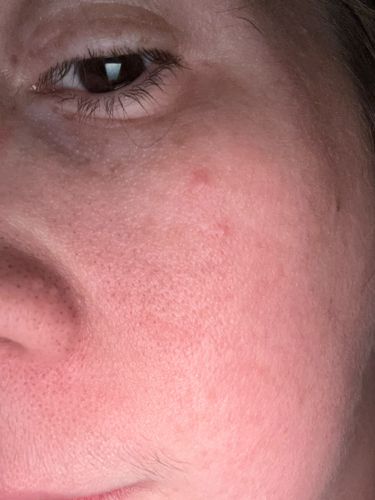 Demodex Mite (often referred to as face mites or eyelash mites)