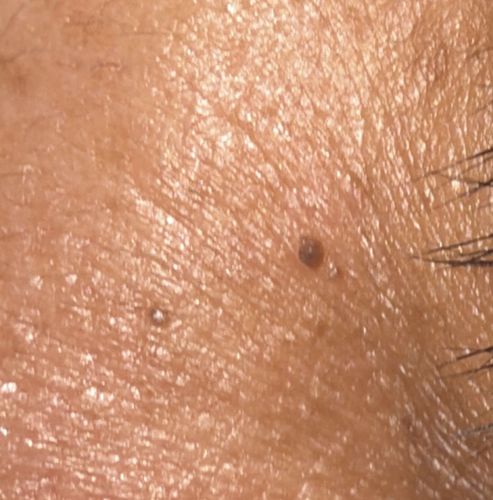 Black-legged Tick (Deer Tick)