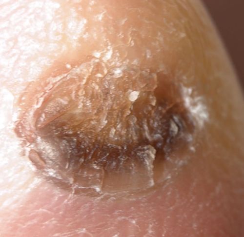 Tungiasis (Jigger flea embedded in skin)