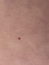 Cherry Angioma