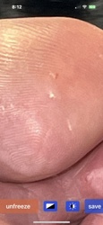 There is no insect or bug visible in the image. The image appears to show human skin, possibly a finger or toe, with some dry patches or small irregularities that are not identifiable as an insect.