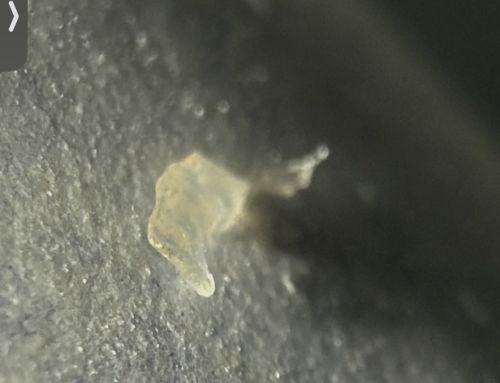 Sebum Plug (Skin Oil Plug) / Dead Skin Flake