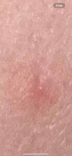 Unknown (Likely a skin reaction, not an insect)