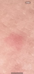 Mosquito (presumed bite reaction)