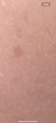 There is no identifiable bug or insect in the image provided. The image appears to show a small, reddish mark on human skin.