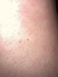 Chigger (Larval Mite)