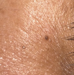 Black-legged Tick (Deer Tick)