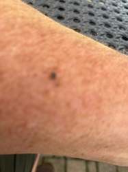 Tick (likely a deer tick or blacklegged tick based on appearance and common occurrence on human skin)