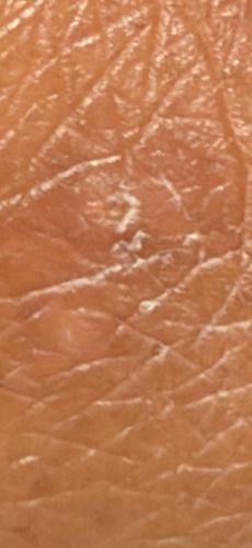 Human Itch Mite