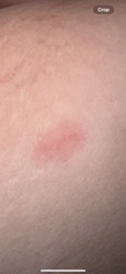 Unknown insect bite (Likely Mosquito, Flea, or similar biting insect)