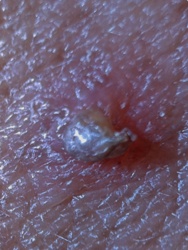 Red Imported Fire Ant (Image depicts the characteristic sting pustule caused by the ant)