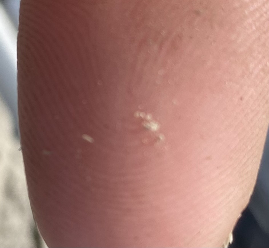 Louse egg (Nit)