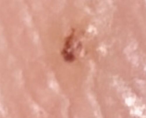 Scabies Mite (or Sarcoptes scabiei)