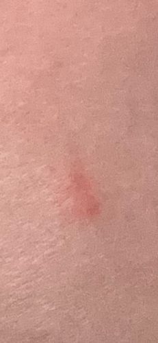 Undetermined insect (bite mark)