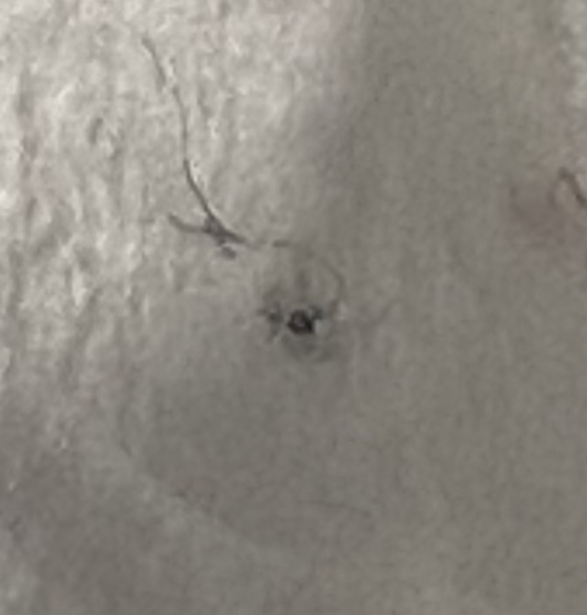Pubic Louse (Crab Louse)