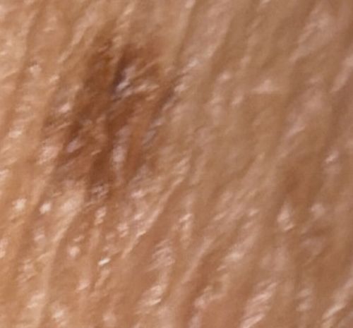 Scabies Mite (Burrow)