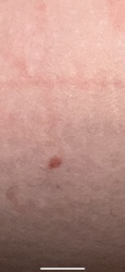 Unknown (potential tick bite/skin irritation)