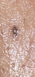 Black legged tick (Deer tick)