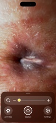 Human Botfly (Larva/Warble)