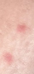 Flea (bite)